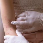 Psoriasis: Causas y medidas preventivas para mantener una piel saludable