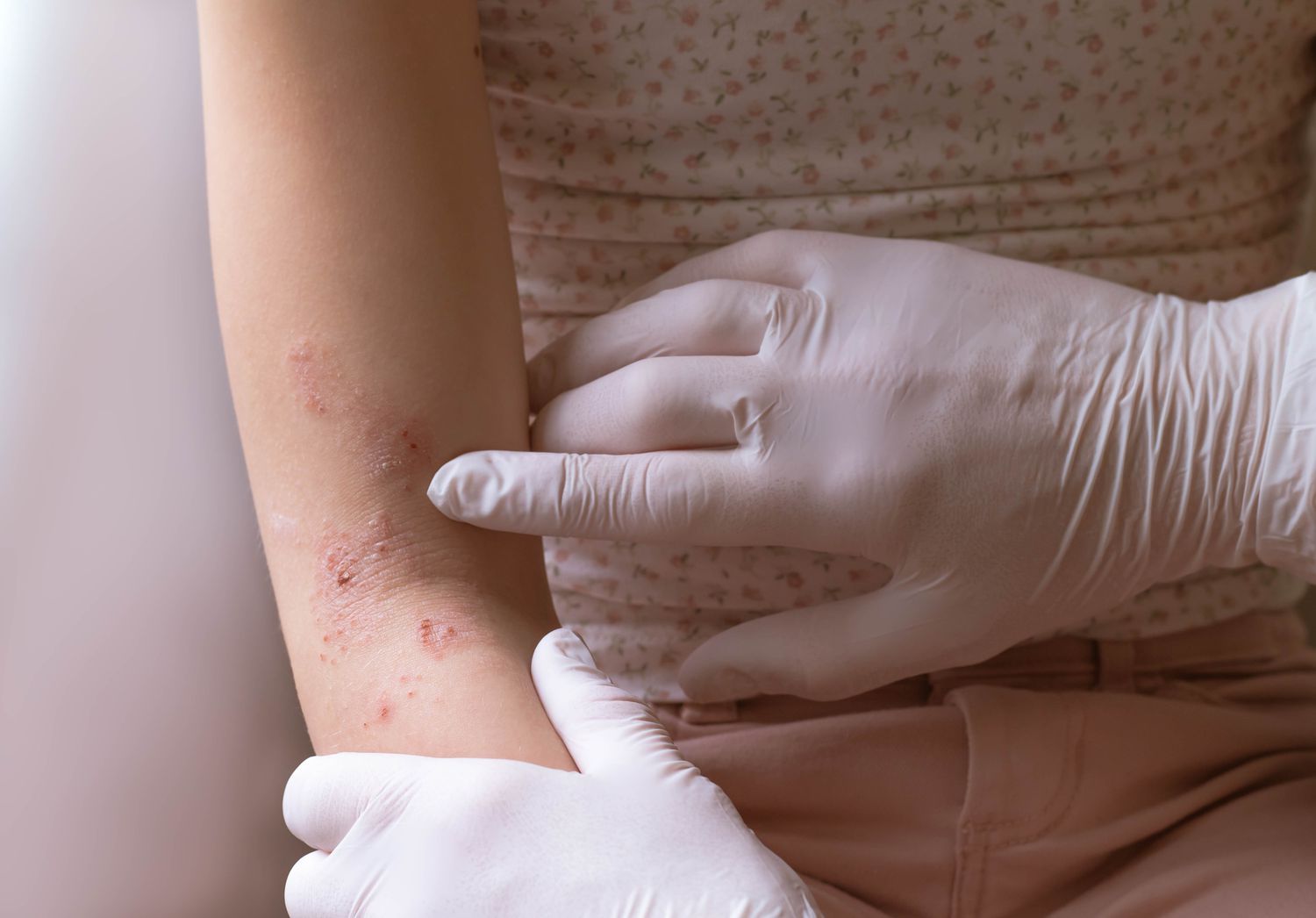 Psoriasis: Causas y medidas preventivas para mantener una piel saludable