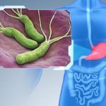 Cómo combatir el Helicobacter Pylori: Remedios caseros y alimentos saludables