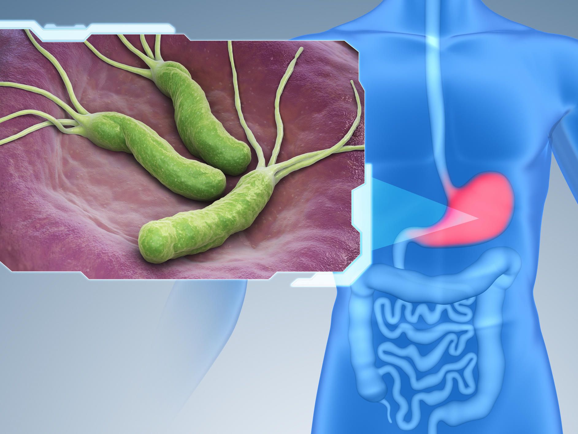 Cómo combatir el Helicobacter Pylori: Remedios caseros y alimentos saludables