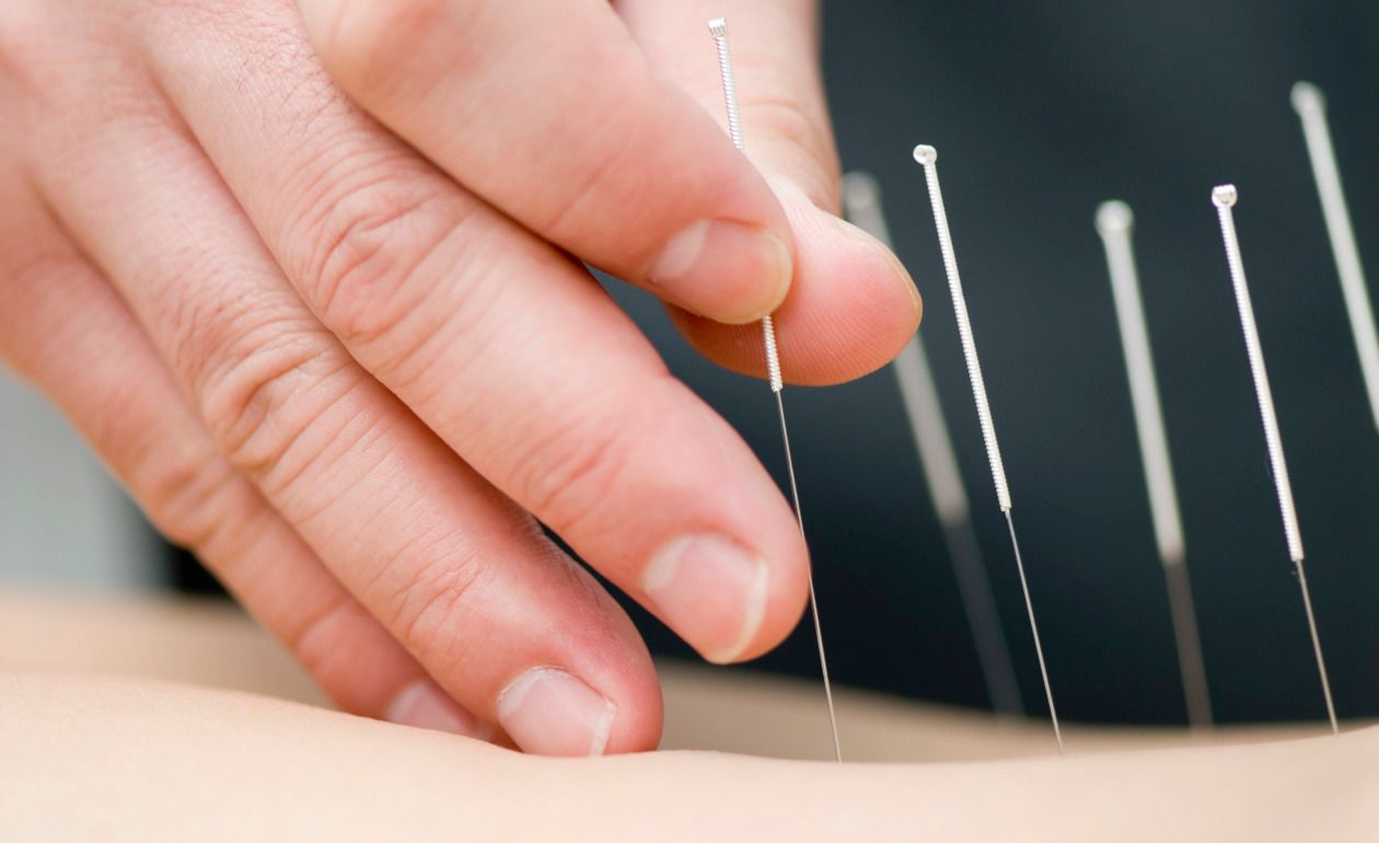 La acupuntura: ¿Qué es y cómo funciona?