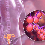 Cómo Reducir el Hongo Candida: Guía Integral
