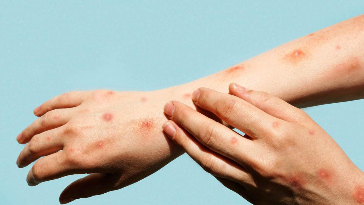 Sanidad Descarta Vacunar Masivamente a los Viajeros por la Viruela del Mono
