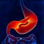 El Remedio Natural más Eficaz contra el Helicobacter Pylori