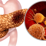 El Enemigo del Cáncer de Páncreas: Descubren Cómo los Fibroblastos Alimentan al Tumor desde Dentro