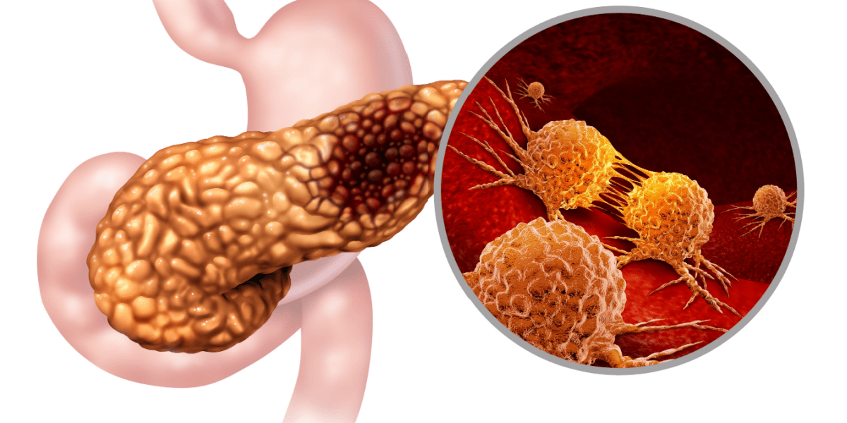 El Enemigo del Cáncer de Páncreas: Descubren Cómo los Fibroblastos Alimentan al Tumor desde Dentro